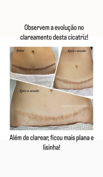 Camuflagem de Cicatrizes