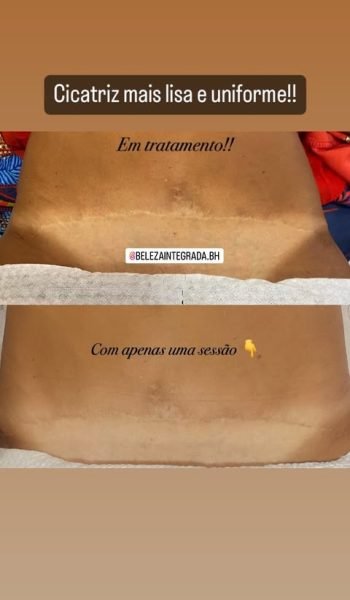 Camuflagem de Cicatrizes